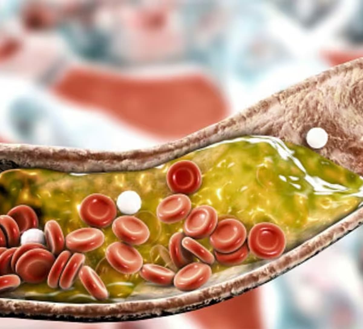 High Cholesterol Management Tips