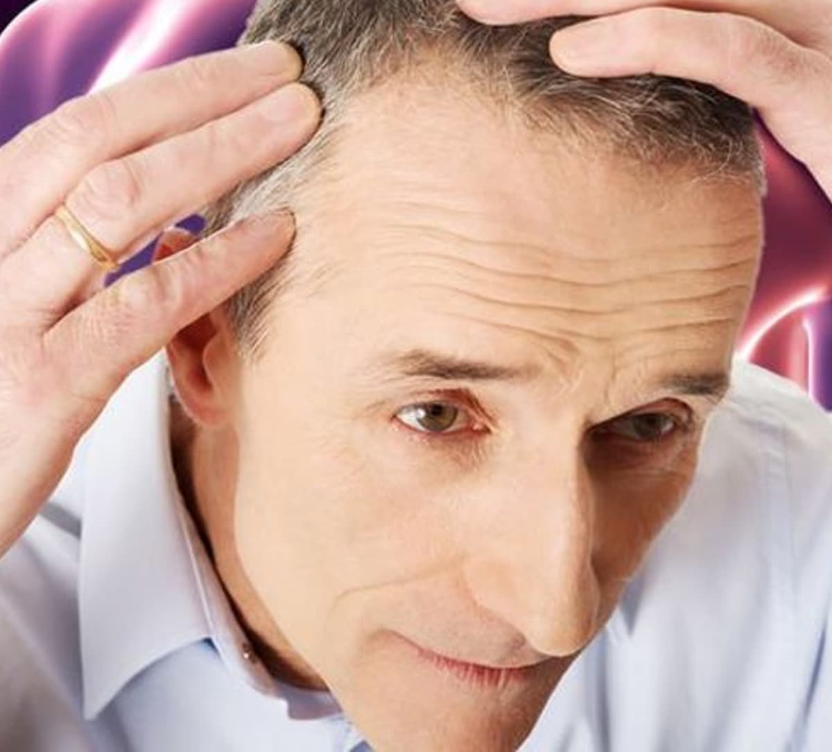 Receding hairline and bald spots on the head